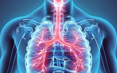 Mengenal Paru Paru Basah dan Penanganan